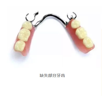 牙齿修复的方式众多,我们究竟该如何选择呢?