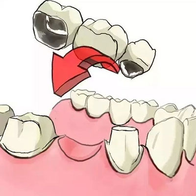 为什么牙缺失后一定要镶牙?