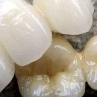 牙齿修复的方式有哪些?怎么选择?