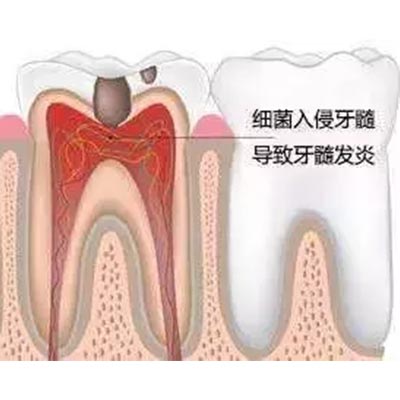 补牙要趁早!小洞不补,大洞吃苦