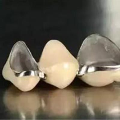 烤瓷牙与全瓷牙,应怎样选?